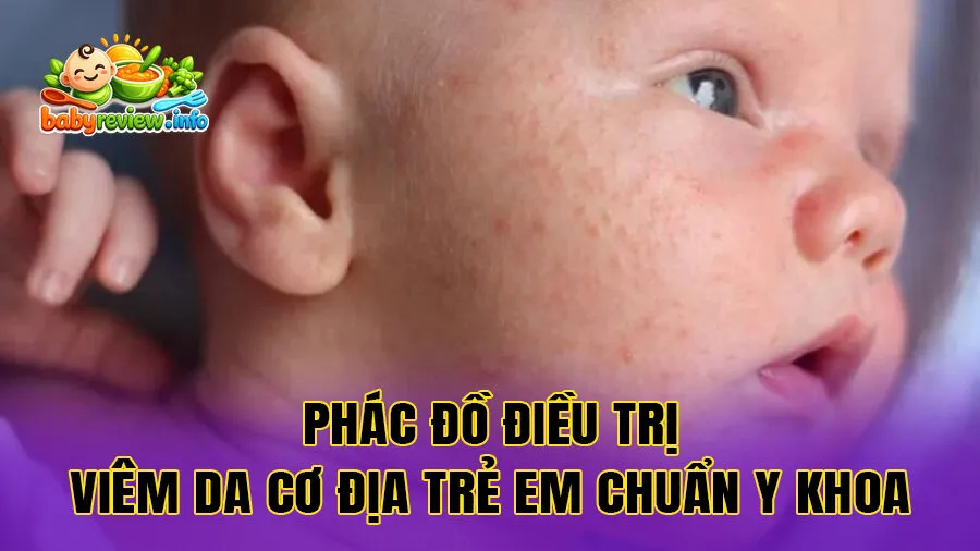 Phác đồ điều trị viêm da cơ địa trẻ em chuẩn y khoa