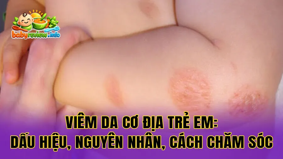 Viêm da cơ địa trẻ em: Dấu Hiệu, Nguyên Nhân, Cách Chăm Sóc