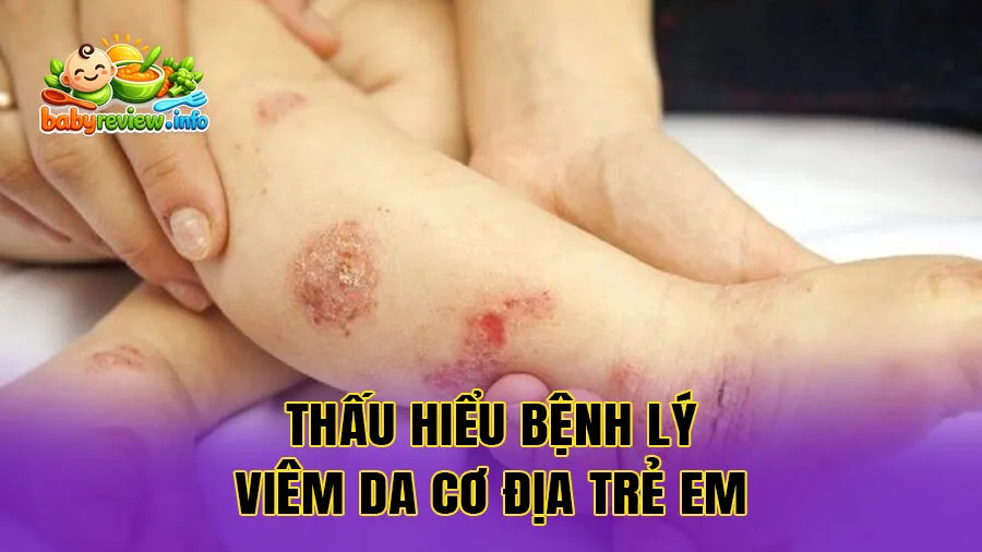 Thấu hiểu bệnh lý viêm da cơ địa trẻ em